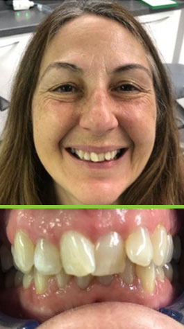 Smile Transformations with Invisalign